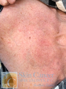 1 Treatment of Fraxel-after