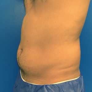 Liposuction #4-before