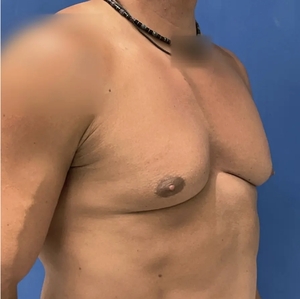 Male Breast Reduction #4 (right oblique)-before