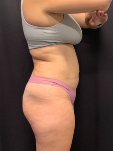 Lipo 360-before