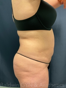 LIPO 2.0-after