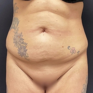 Tummy Tuck #10-before