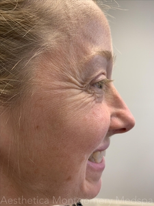 Jeuveau crows feet-before