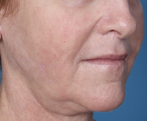 Skin Texture and Laxity-before