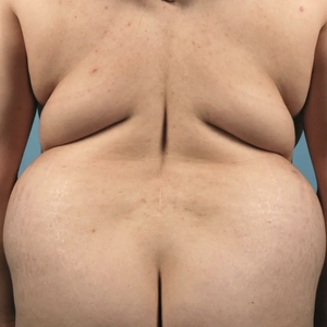 Mommy Makeover #9-before