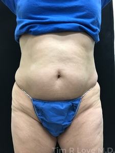Abdominoplasty - Traditional-before
