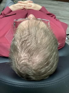 First Round of PRP for Plaque Psoriasis and thinning hair-after