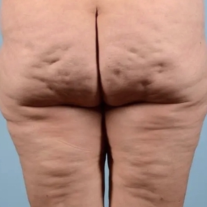 Cellulite Reduction #1-before