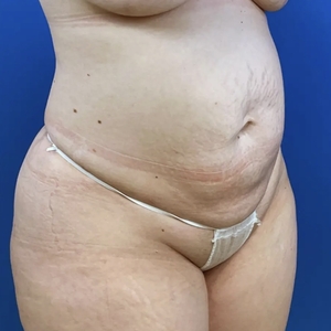 Lipo w Renuvion #8-after