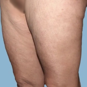 Cellulite Reduction #1-after