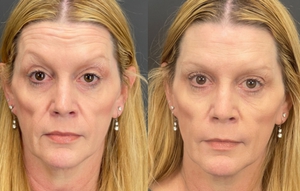 26443 - 6 units botox forehead-before