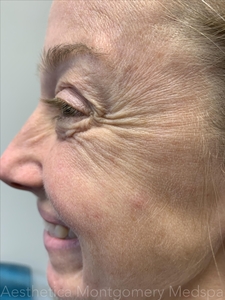 Crows feet Jeuveau-before