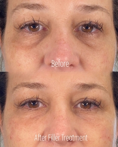 Filler B/A SBA 28-before