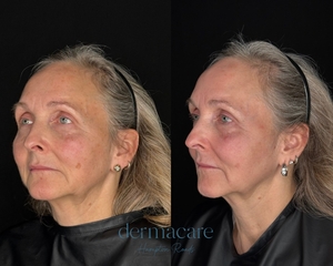 Halo - Carrie Labert PA-C-before