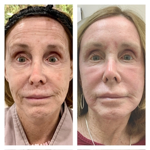 1 week post Treatment for hyperpigmentation, wrinkles, skin tightening-before