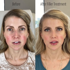 Filler B/A SBA 10-before