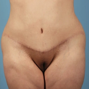 Mommy Makeover #3-after