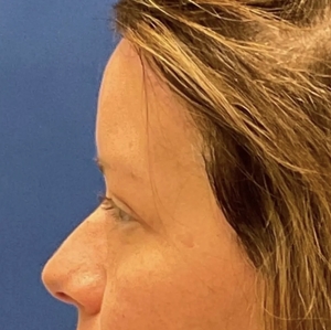 Brow & Eye Lift #2-after