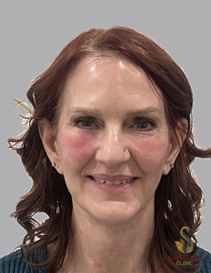 Cellenis Derma PRP 22ml, Facial balancing-after