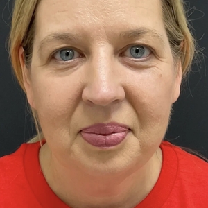 Lipo w Skin Tightening Face #3-before