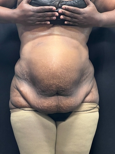 Tummy Tuck w/ plication + liposuction-low back + waist-after