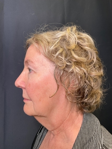 NECK AND LOWER FACE-before