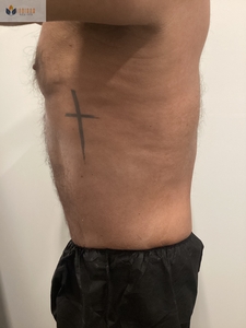 After 1 Instasculpt treatment-after