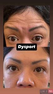 Dysport-before