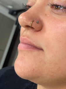 Danielle Glass RN. - Volbella-before