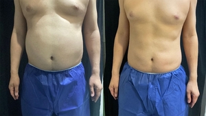 coolsculpting+cooltone-12-treatments-before