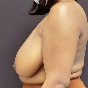 Breast Reduction #1-before