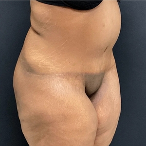 Tummy Tuck #18 (oblique right)-after