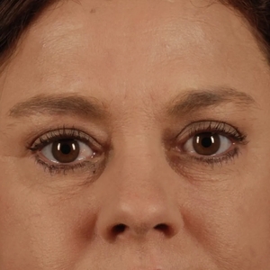 Brow & Eye Lift #5-after