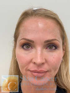 Cheek and Jaw Filler with Threads-after