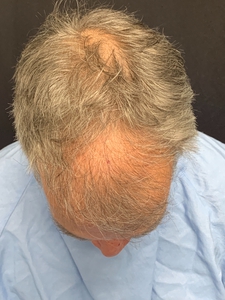 Neograft 1400 grafts-after