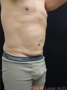 Abdominoplasty - Mini-before