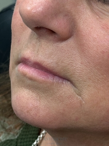 Tori Atkins RN, Versa-before