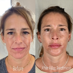 Filler B/A LP-before