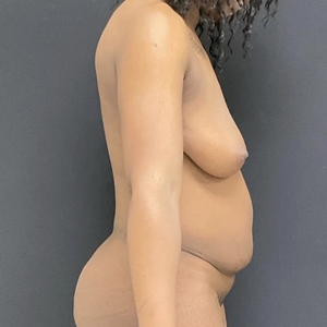 Mommy Makeover #15-before