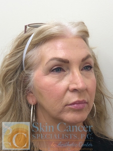 Nova Threads and Filler-after