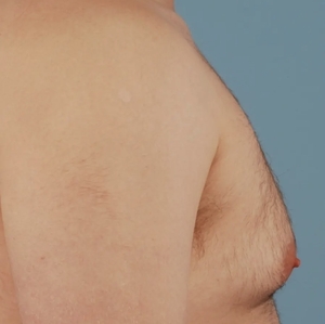 Male Breast Reduction #12-before