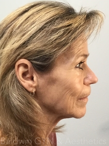 LOWER FACE PLUS MIDFACE FILLER-before