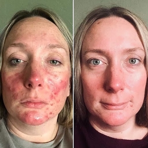 ROSACEA-before