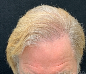 Transplant - Men-after