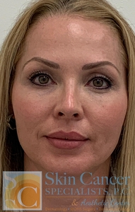 Cheek and Jaw Filler with Threads-before