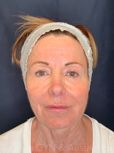 lower face only-before