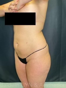 plus lipo 2.0-after