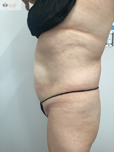 2 Treatments of Insta Abd-after