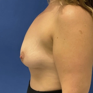 Breast Augmentation #7 305/385 cc-before
