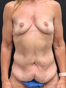5'2, 120lb, 50 year old post-bariatric surgery patient. She is 3 months post op circumferential body lift with gluteal fat grafting and mastopexy with 345cc shaped highly cohesive implants.-before